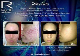 regima peel heal 3