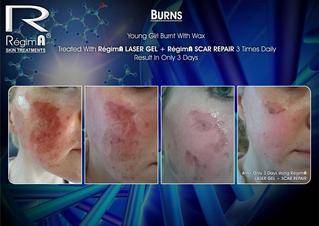regima scar cream before after 2