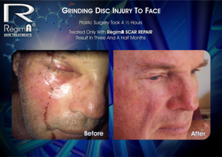 regima scar repair before and after 1